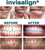 ortodontie-terapia Invisalign