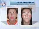 lifting facial