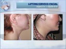 lifting facial iasi