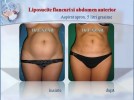 liposuctie abdomen