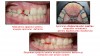 disjunctie ortodontica