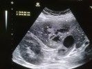 Colecistita acuta litiazica, abces hepatic. 24 de ani, sex feminin.