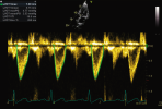 Imagine demo Vivid AI Cardiac Auto Doppler