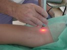 Fotobiostimulare laser  - plagÄƒ veche