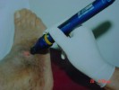 Ulcer cronic (vechi de 3 ani) imposibil de vindecat prin mijloace de medicinÄƒ alopatÄƒ, sub tratament cu LASER.