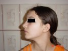 Acnee juvenilÄƒ dupÄƒ 7 ÅŸedinte de tratament cu LASER