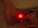 Fotobiostimulare LASER