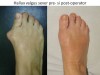 Hallux valgus ultra-sever de tip juvenil