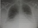 Edem pulmonar