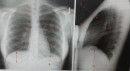 Radiografie toracica normala