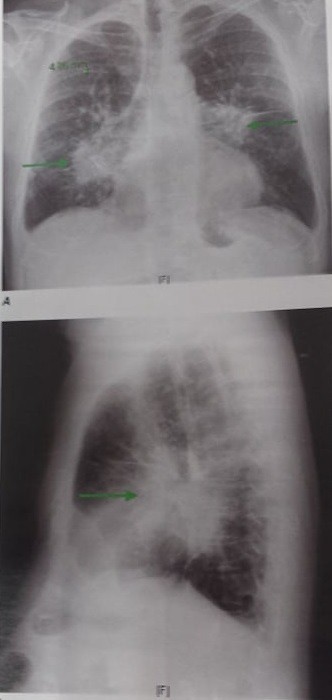 leziuni pulmonare în bolile difuze ale țesutului conjunctiv)