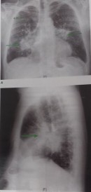 Sarcoidoza - radiografie toracica in stadiul II