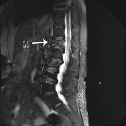 Rezonanta magnetica vertebrala arata tasarea discului vertebral