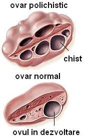 chisturi ovariene