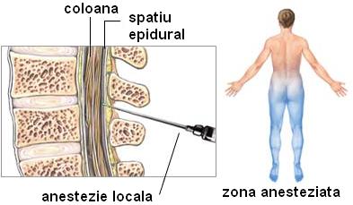 anestezie epidurala sarcina