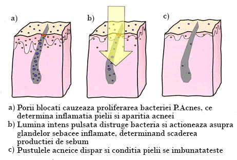 tratament acnee