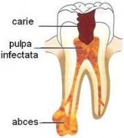 abces_dentar