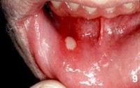 ulcer_aftos