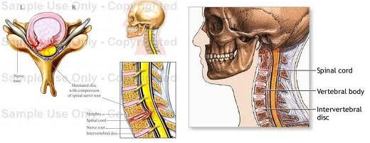 spondiloza cervicala c5 c6