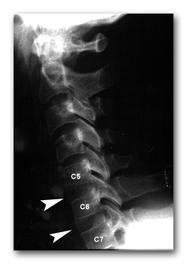 spondiloza cervicala c5 c6)