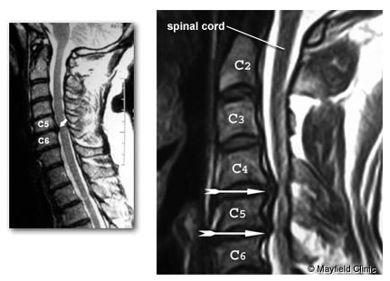 hernia coloanei cervicale și a vederii oftalmolog polimixina b trimetoprim