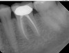 radiografie_retroalveolara