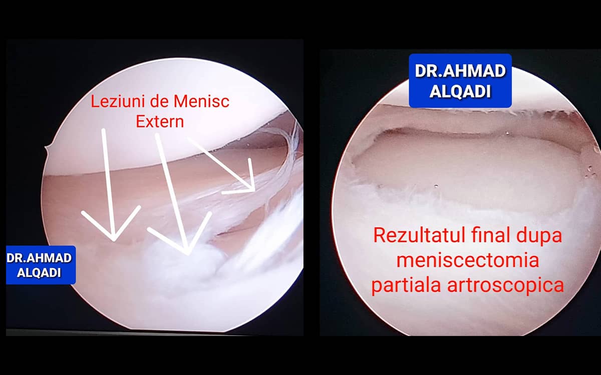 Foto: ruptura de mensic, menisectomie partiala