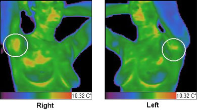 Asimetria termică  a desenului vascular a regiunii axilare