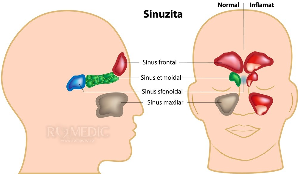 simptomele paraziților din sinusuri