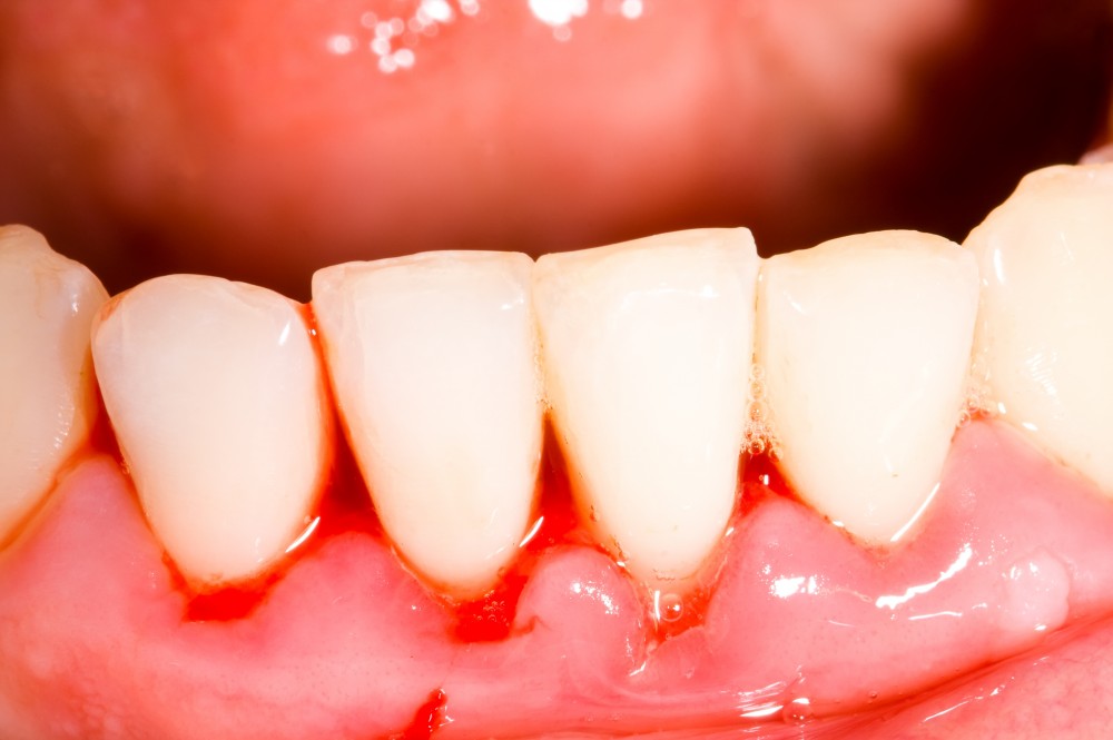 Durerea de dinți – de ce apare și cum o tratăm