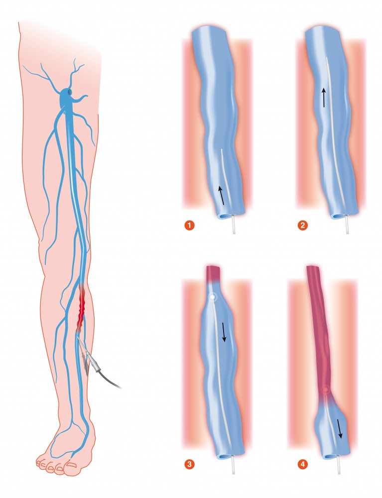 arterita obliteranta imagini