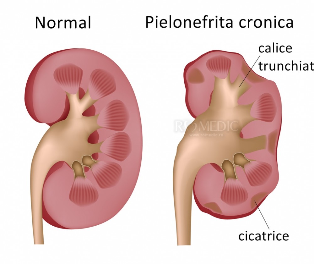 dureri articulare cu pielonefrită