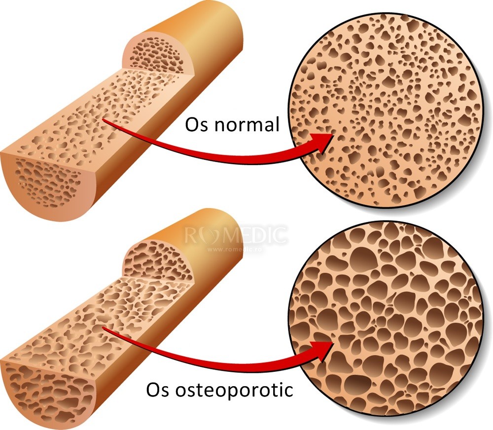 Osteoporoza: cauze, simptome si tratament | adamos.ro