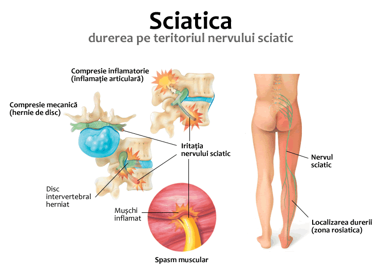 durere în articulația sciatică