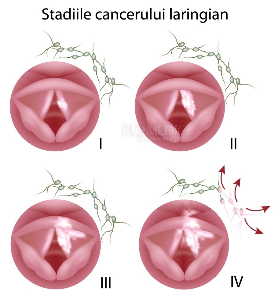 cancerul laringian simptome