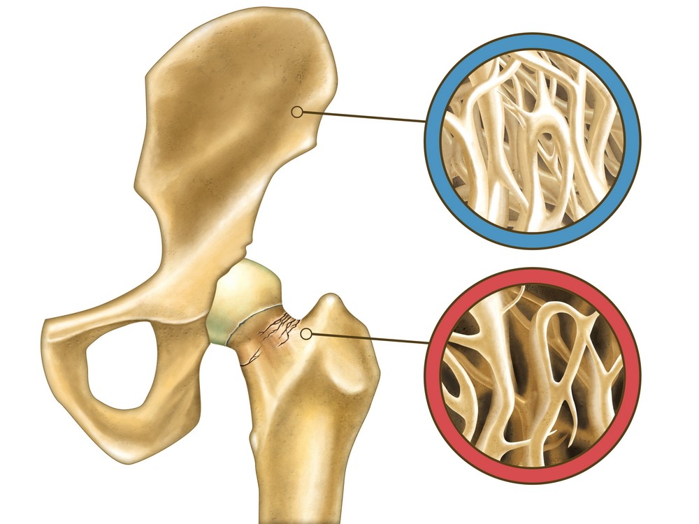 unguente pentru osteoartrita articulației umărului