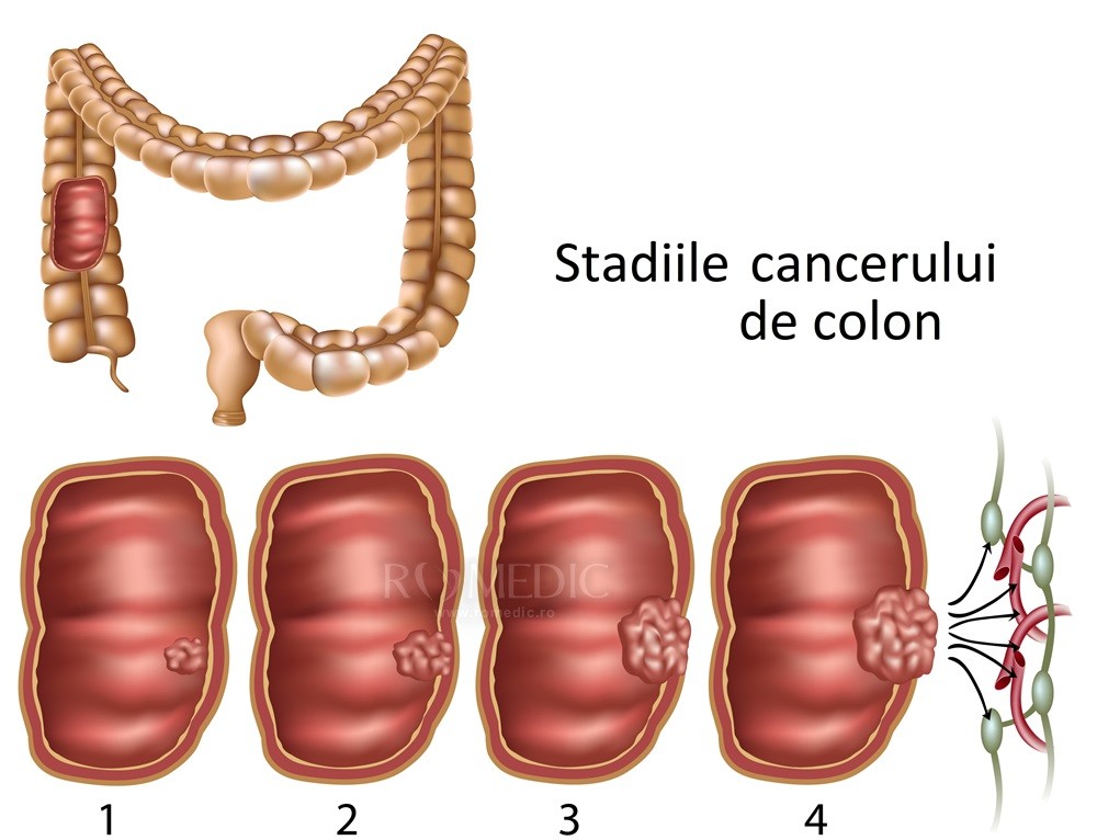 Cancerul de colon – semne si simptome care nu trebuie ignorate