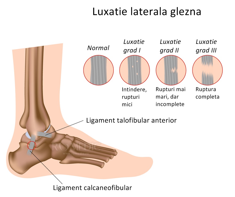 tipuri de durere în articulația gleznei