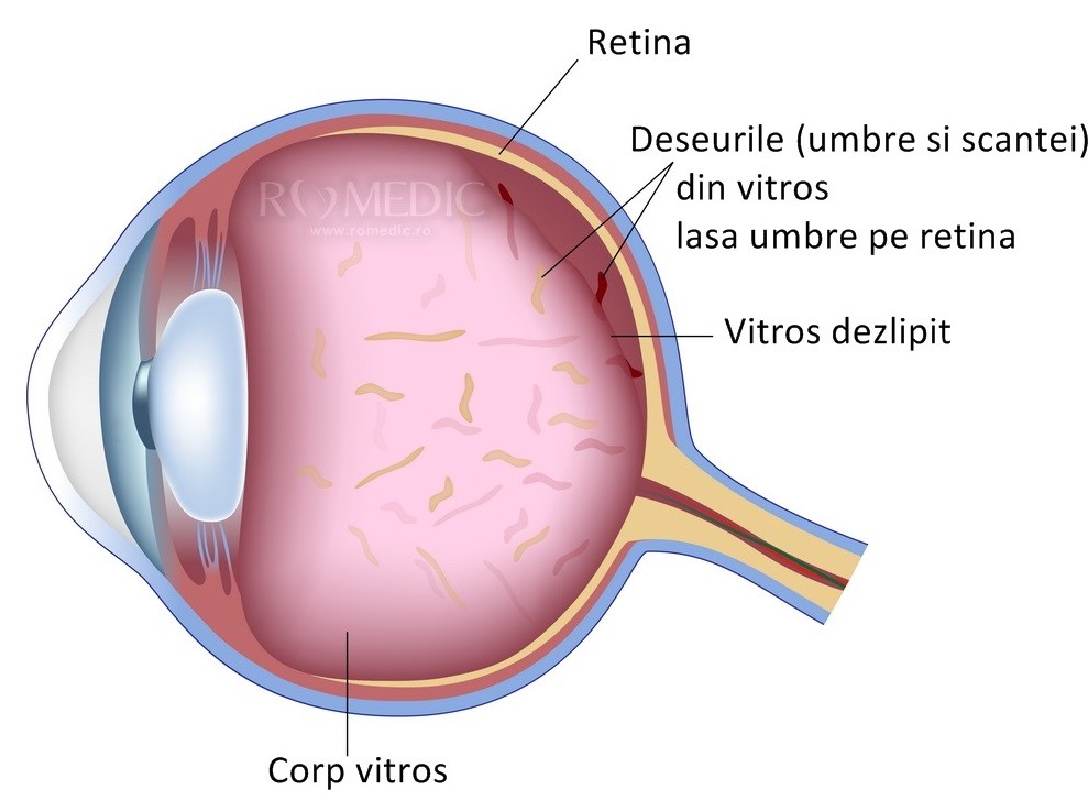 sclera ochii miopie)