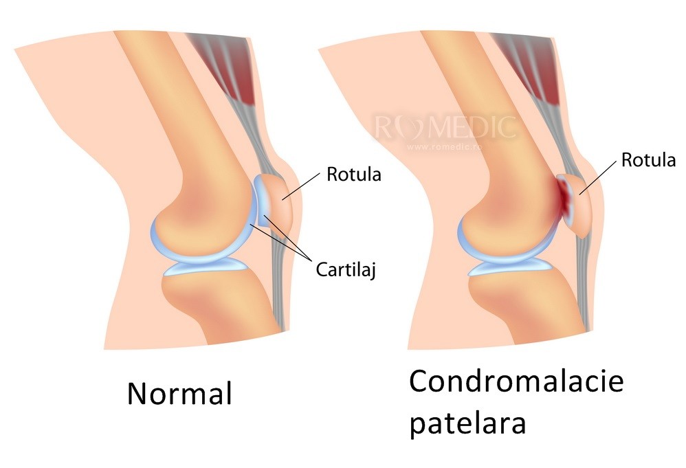 Artroza – ce este, tratament si simptome