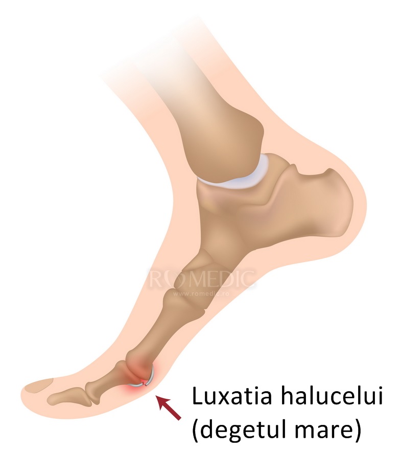 Degetul mare de la picior umflat și roșu = gută?