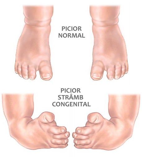 artrita piciorului index