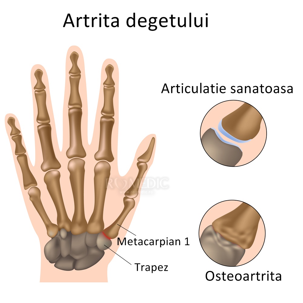 artrita tratarea degetelor