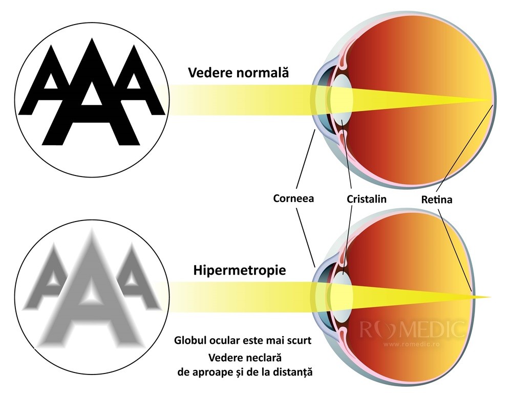 hipermetropie slabă ochii asupra vederii