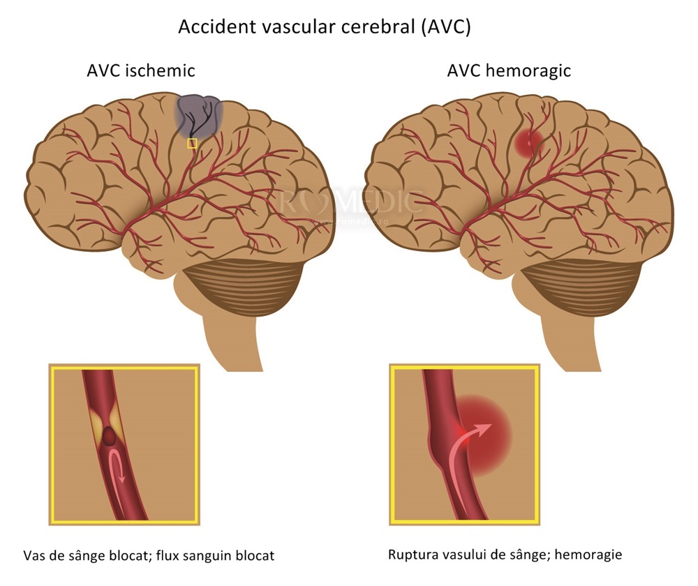 dureri articulare cu accident vascular cerebral ischemic)
