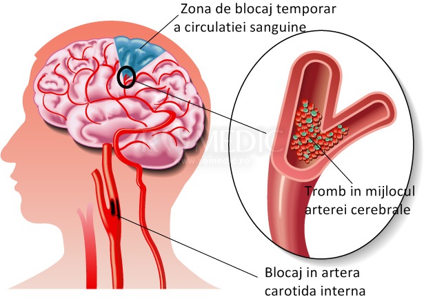 pierderea în greutate din cauza accidentului vascular cerebral