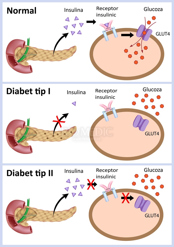 Potasiu si diabetul