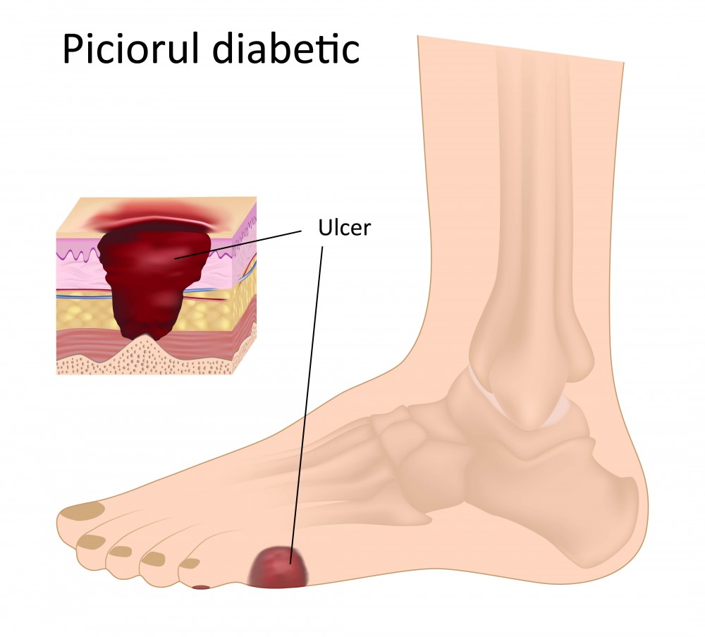 Picior Diabetic: Cauze, Diagnosticare, Simptome, Tratament & Preventie