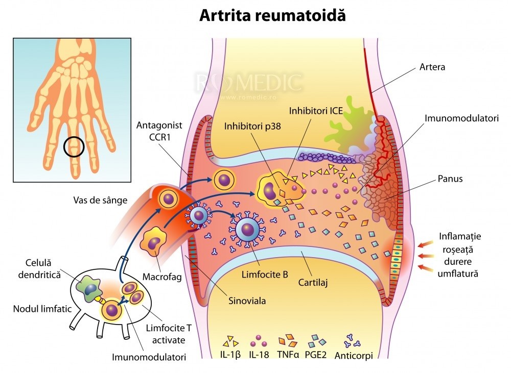 artrita reumatoidă a articulațiilor)