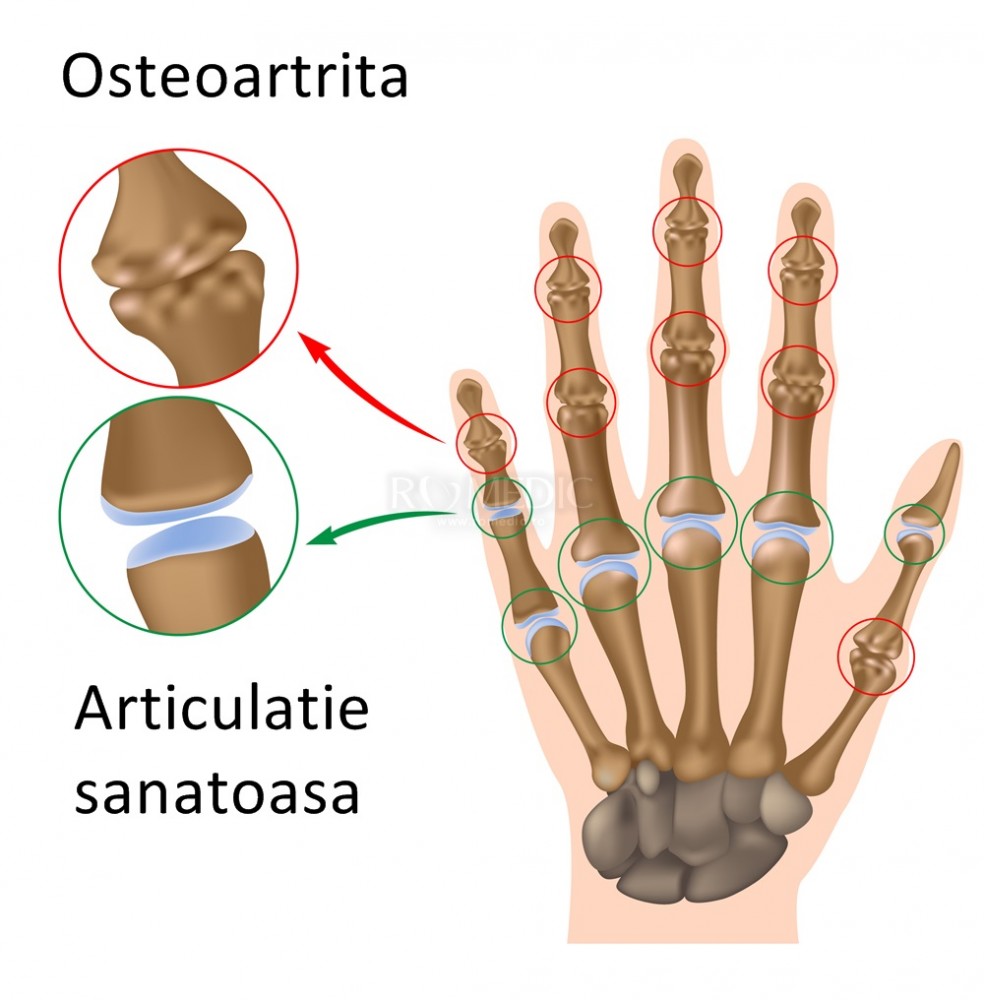 osteoartrita cronica)